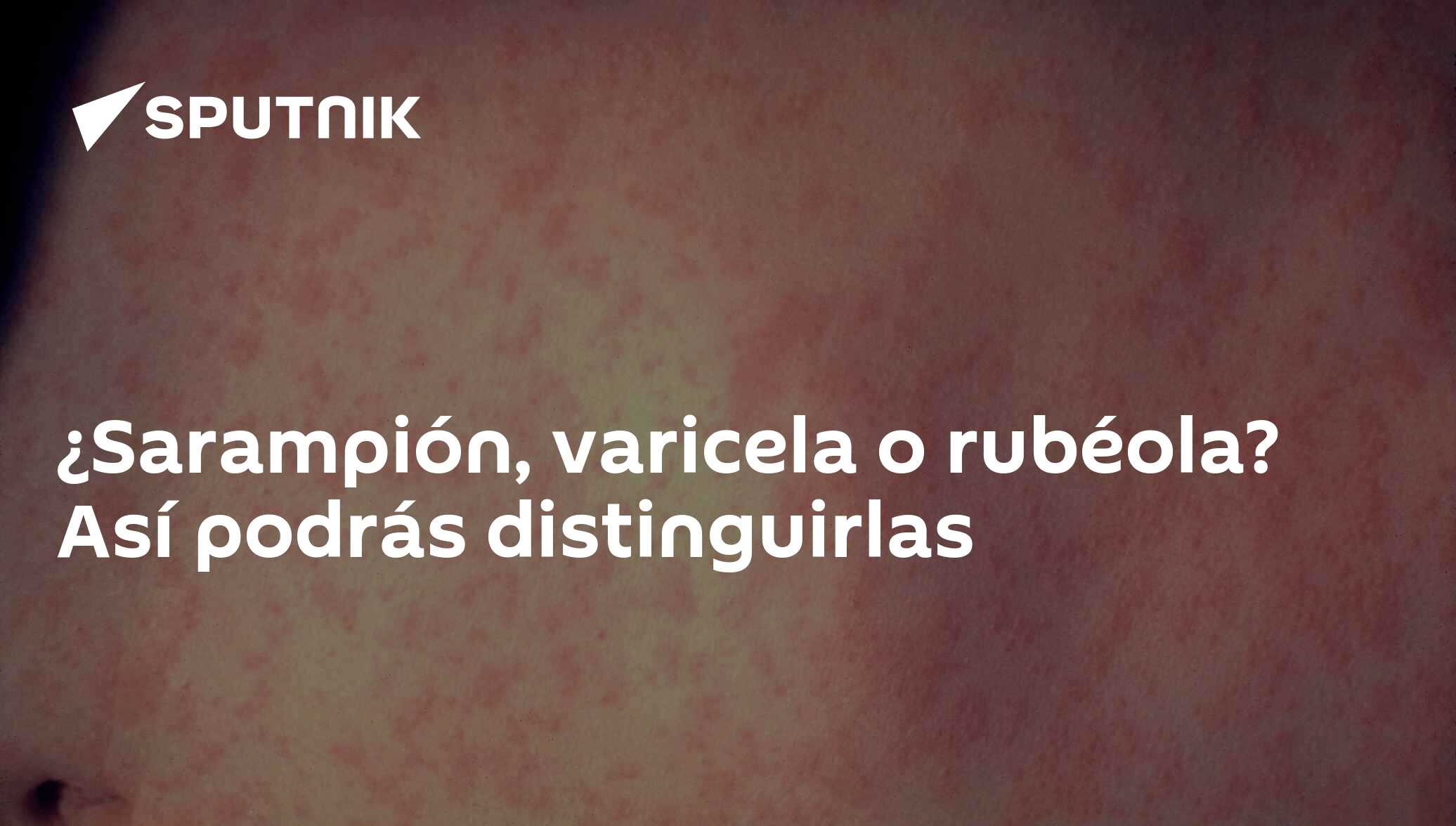 ¿sarampión Varicela O Rubéola Así Podrás Distinguirlas 16 04 2019