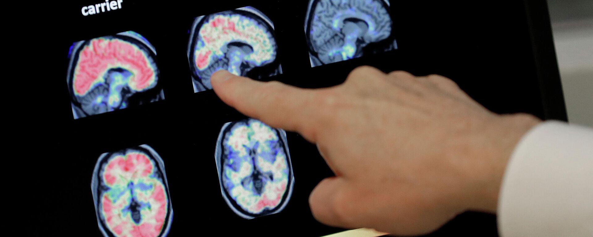 En esta foto de archivo del 14 de agosto de 2018, un médico observa una tomografía computarizada de un cerebro.  - Sputnik Mundo, 1920, 17.07.2022