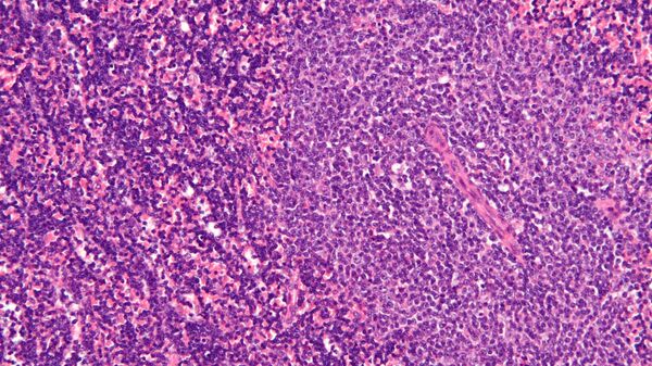 Micrografía de un nodo linfático afectado por leucemia linfocítica crónica - Sputnik Mundo