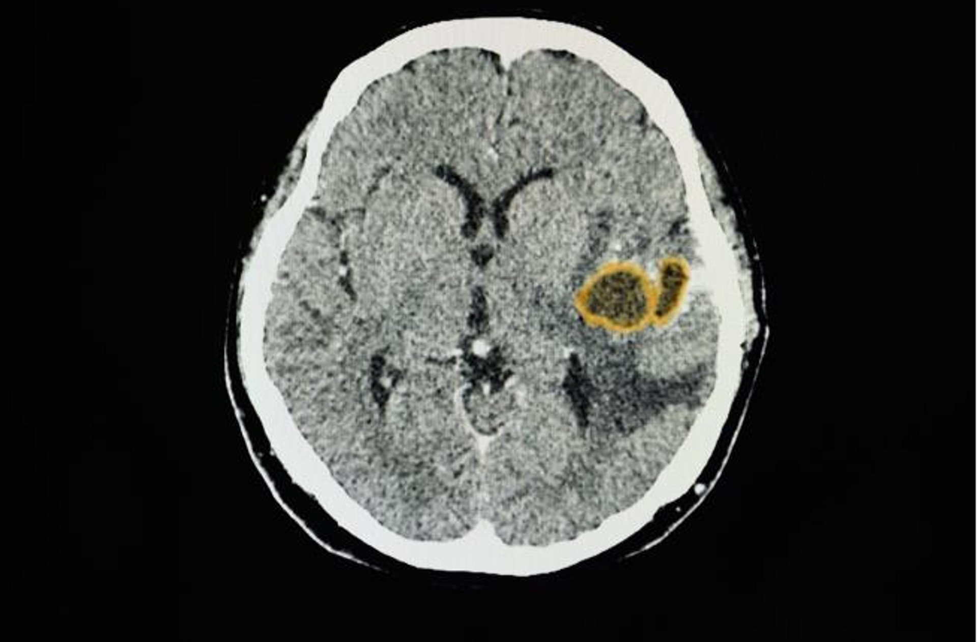 Una tomografía computarizada del paciente con abscesos cerebrales en el lóbulo temporal izquierdo - Sputnik Mundo, 1920, 30.04.2023