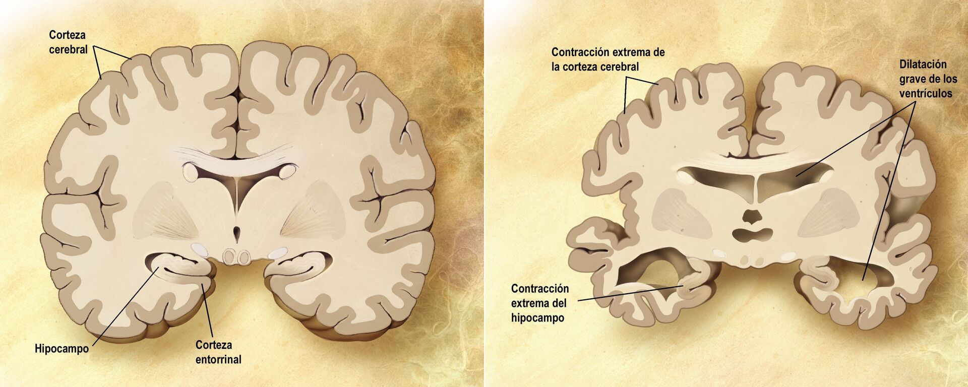 Imagen del cerebro normal y del cerebro en la enfermedad de Alzheimer - Sputnik Mundo, 1920, 15.09.2023