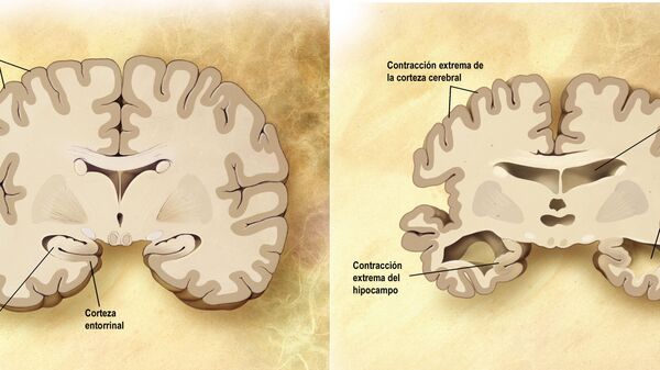 Imagen del cerebro normal y del cerebro en la enfermedad de Alzheimer - Sputnik Mundo