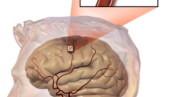 Ilustración de un ictus embólico, que muestra un bloqueo alojado en un vaso sanguíneo. - Sputnik Mundo