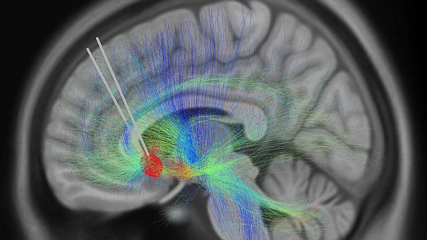 Los escáneres cerebrales detectaron un biomarcador de recuperación de la depresión. - Sputnik Mundo