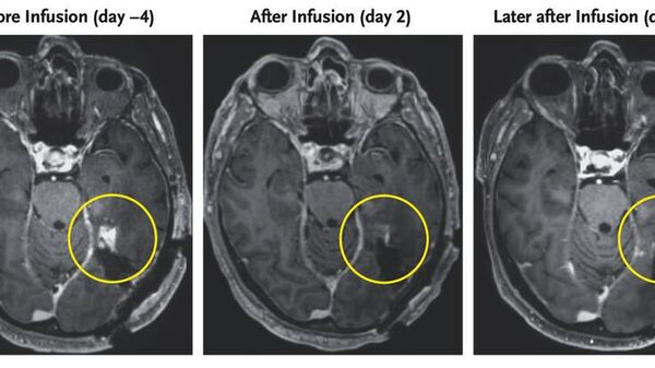 Resonancia magnética de un paciente de 72 años con un glioblastoma - Sputnik Mundo