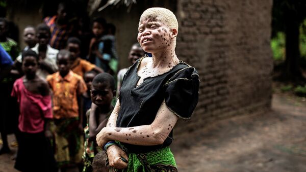 Mainasi Issa, una albina de Malaui - Sputnik Mundo