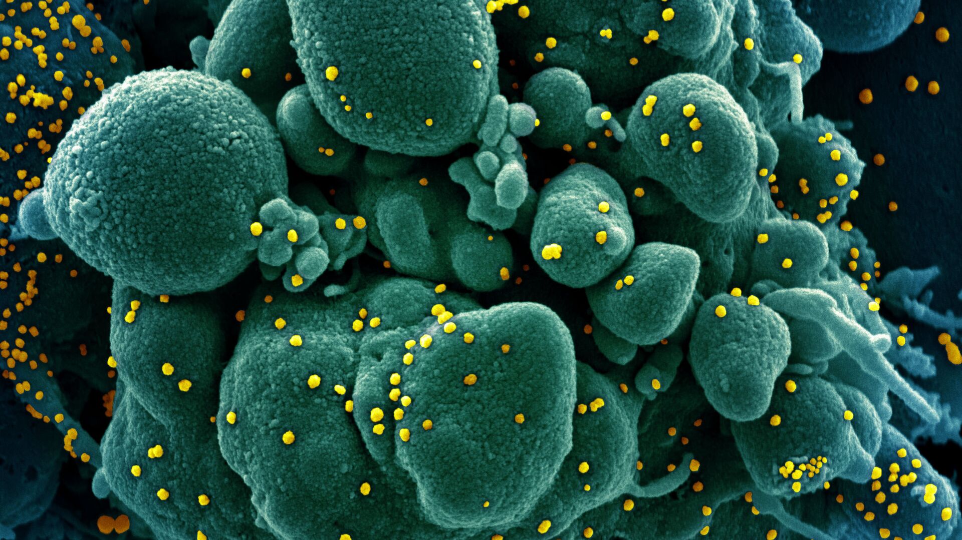 Micrografía electrónica coloreada de una célula humana (azul-verde) infectada por el virus SARS-COV-2 (amarillo) - Sputnik Mundo, 1920, 27.08.2021