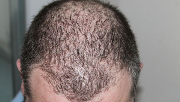 Hombre con alopecia - Sputnik Mundo
